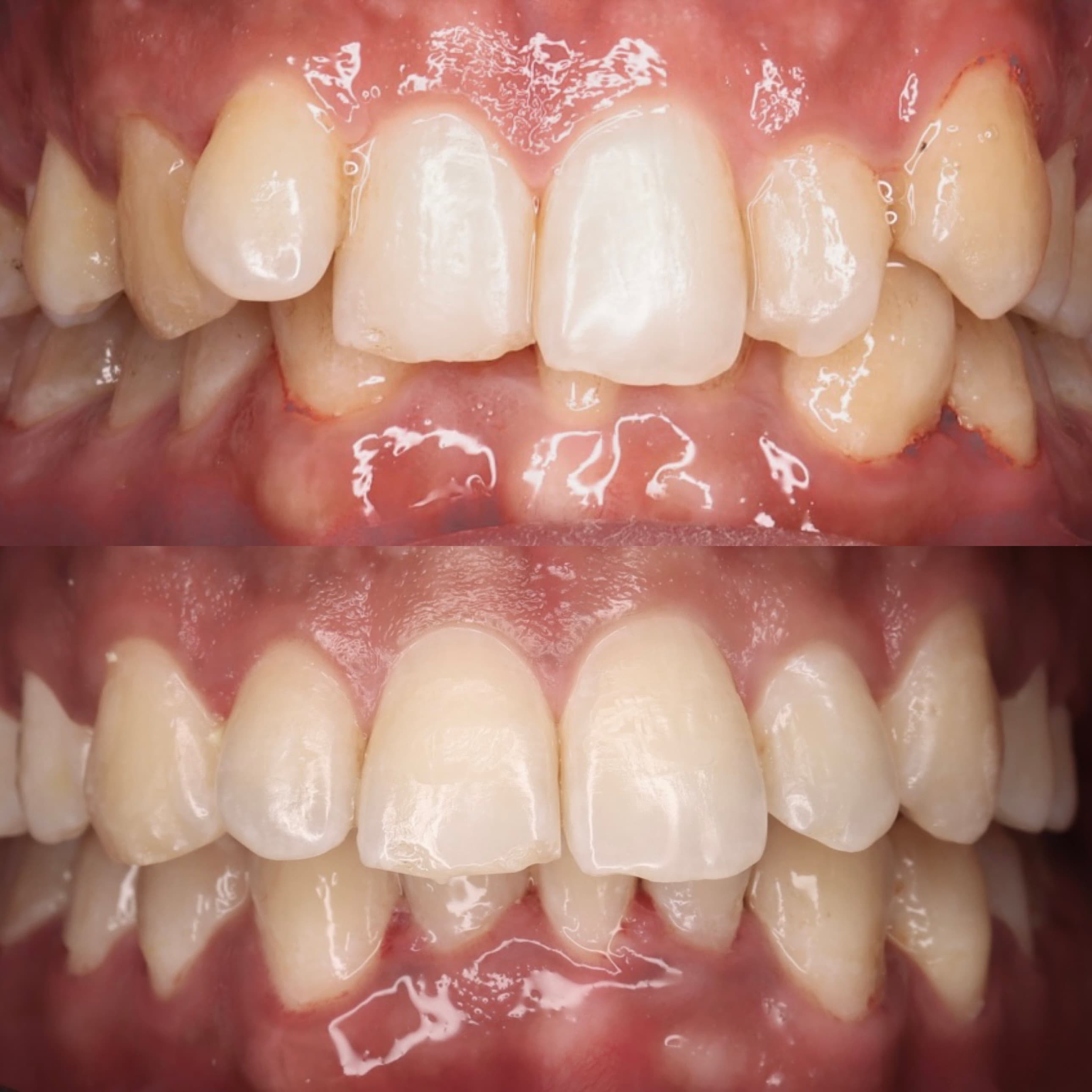 Aligners: before and after dental transformation