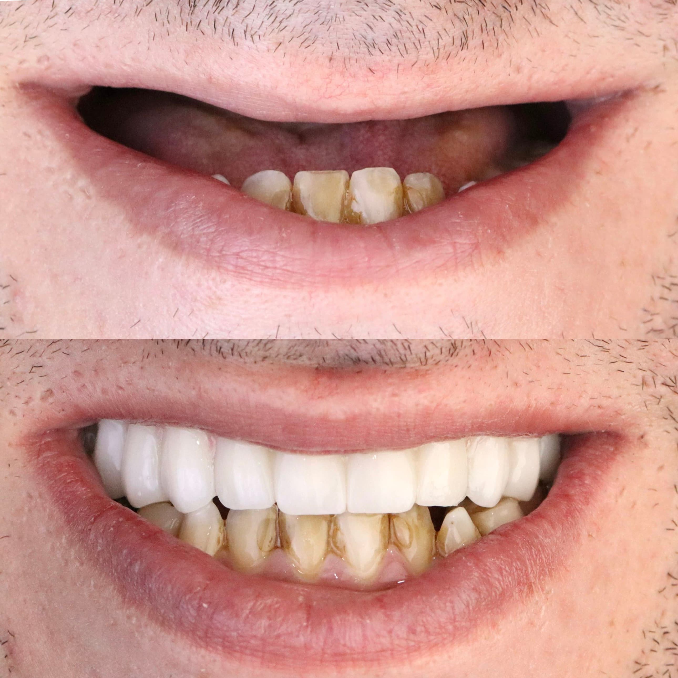 Upper Arch All-on-6 Crowns on Implants: before and after dental transformation