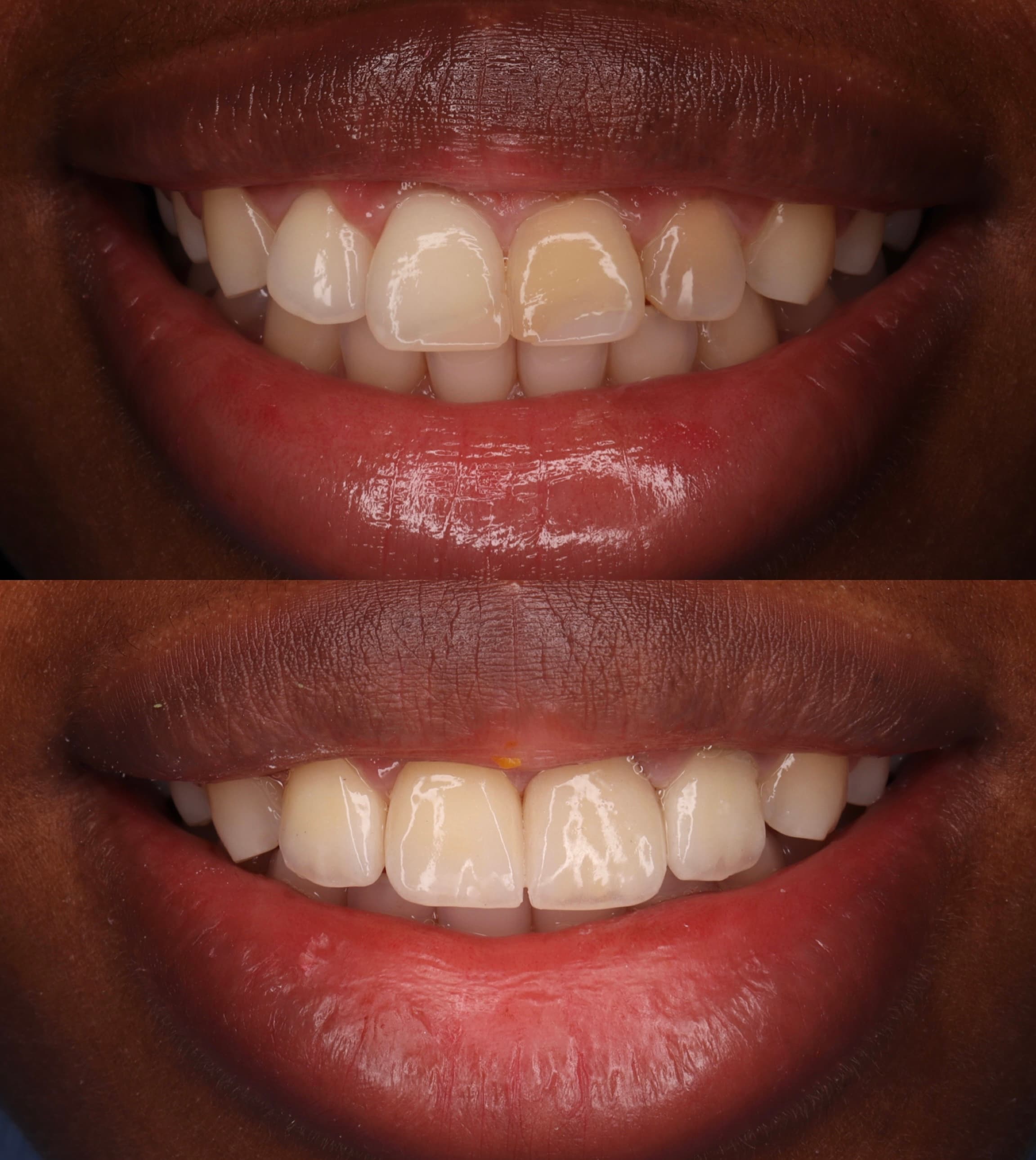 Composite Veneers: before and after dental transformation