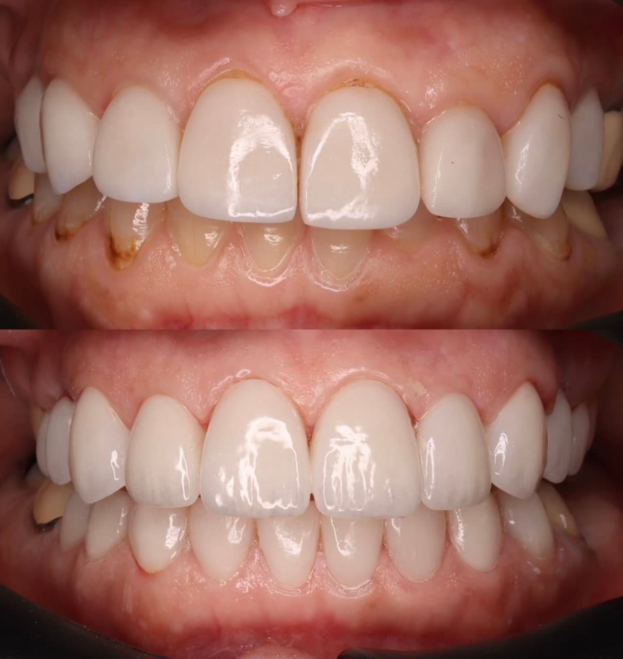 Emax Veneers and Gums Contouring: before and after dental transformation