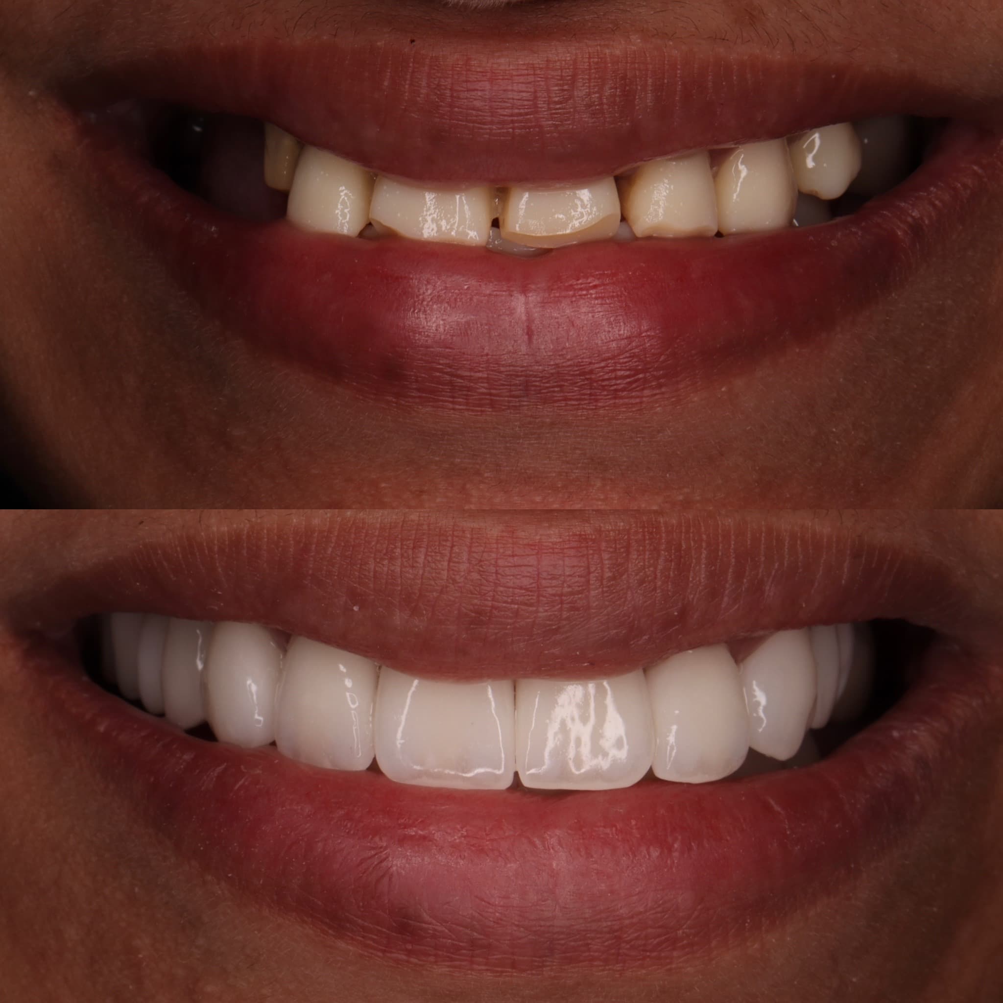 Emax Veneers: before and after dental transformation