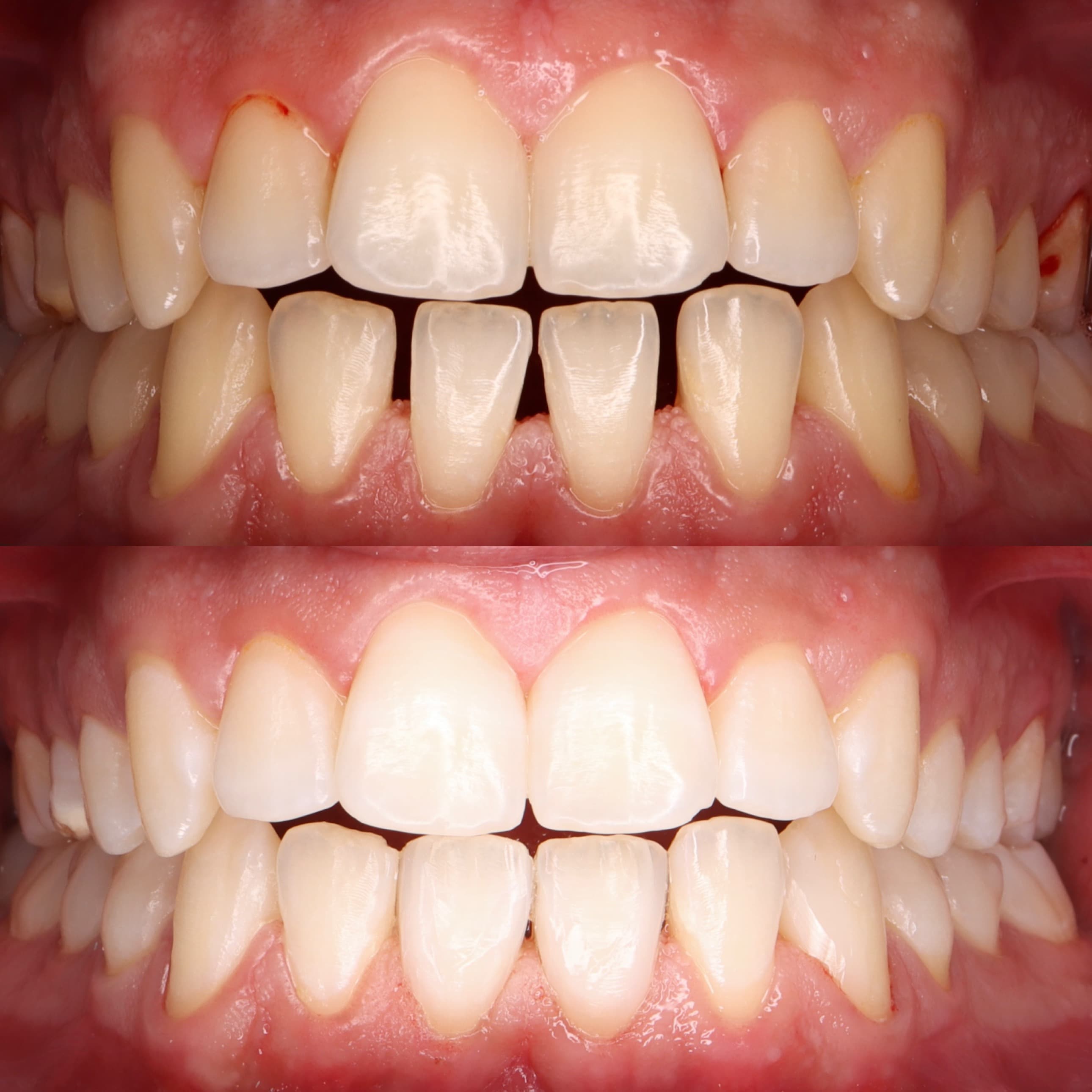 Lower arch composite veneers and bleaching: before and after dental transformation