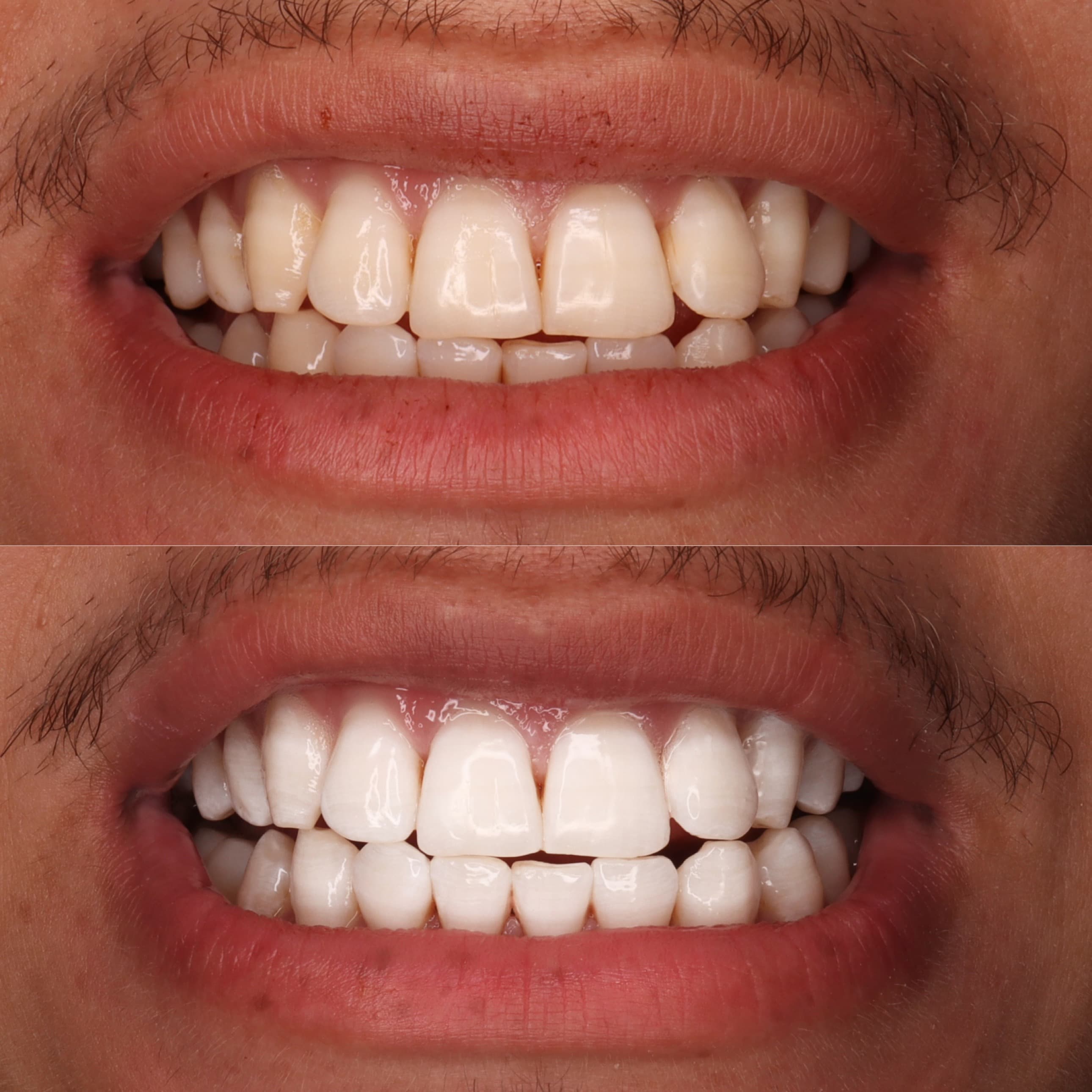 Scaling and Bleaching: before and after dental transformation