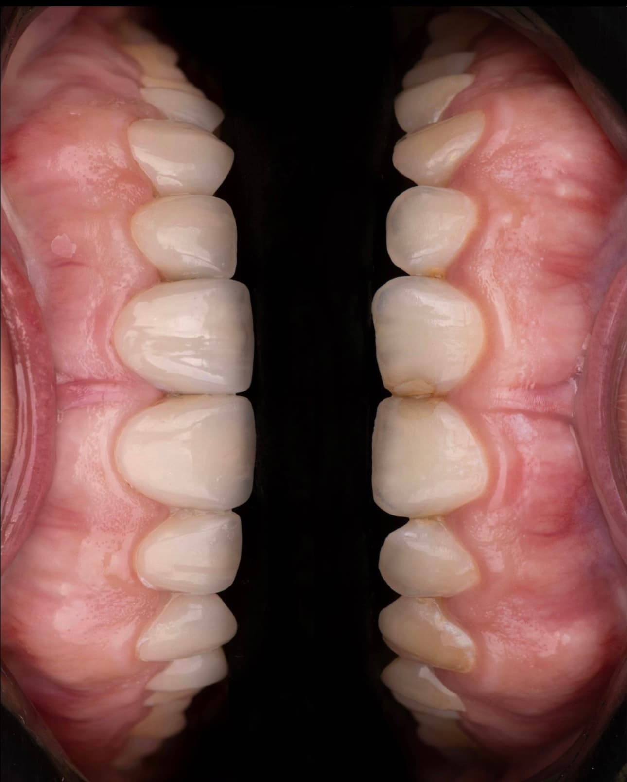 Veneers and Gum Contouring: before and after dental transformation