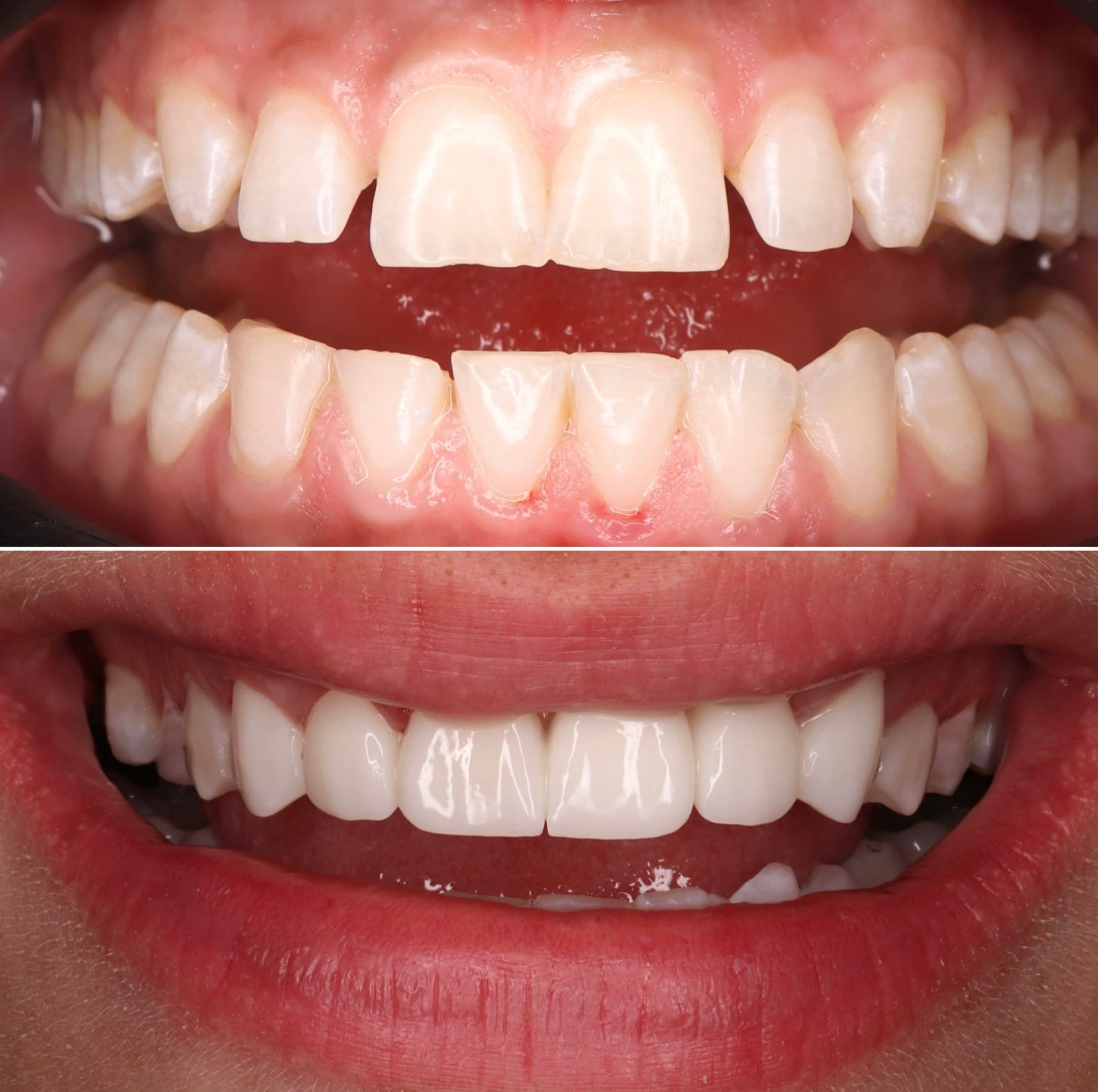 Veneers: before and after dental transformation