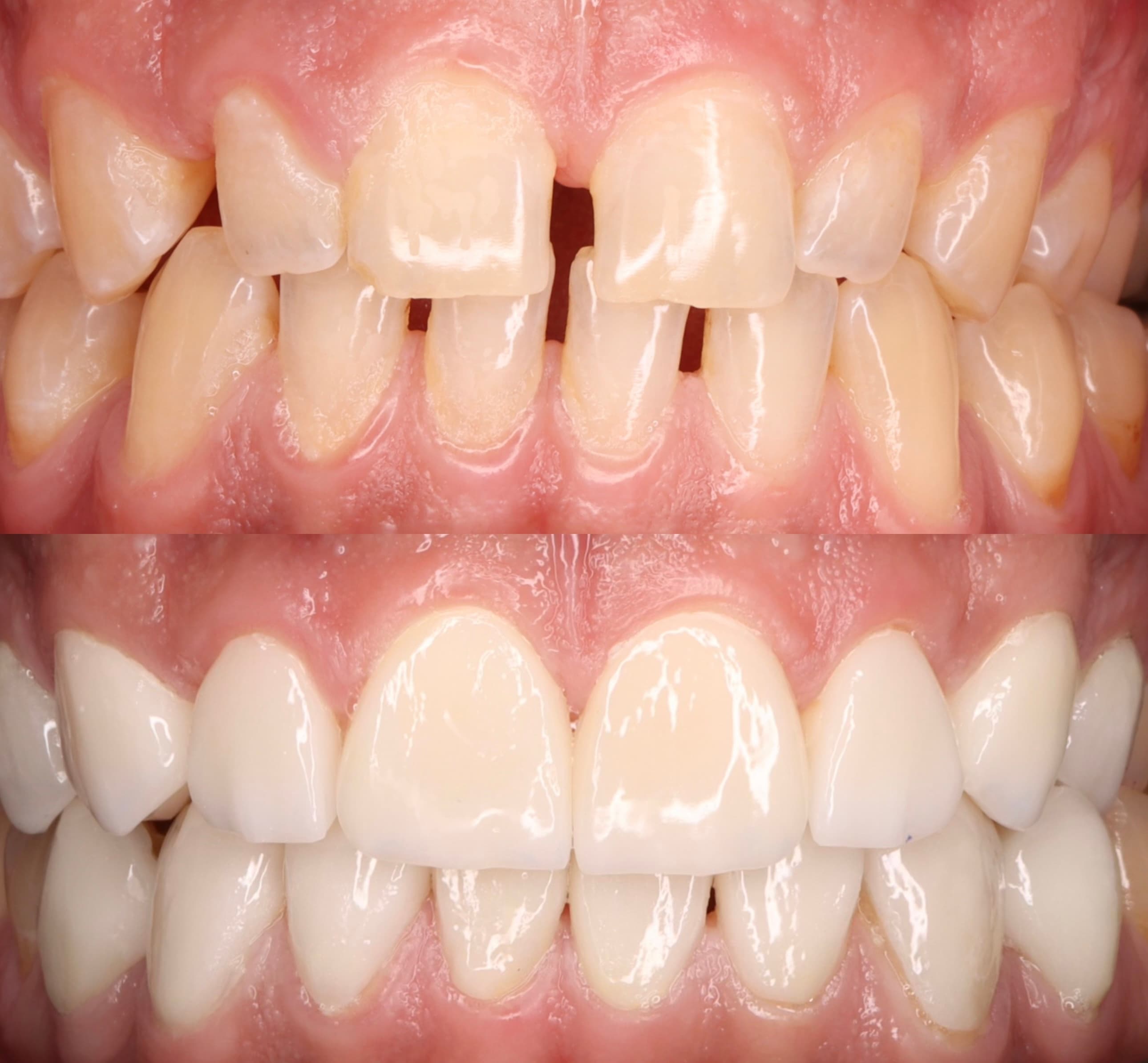 Veneers: before and after dental transformation