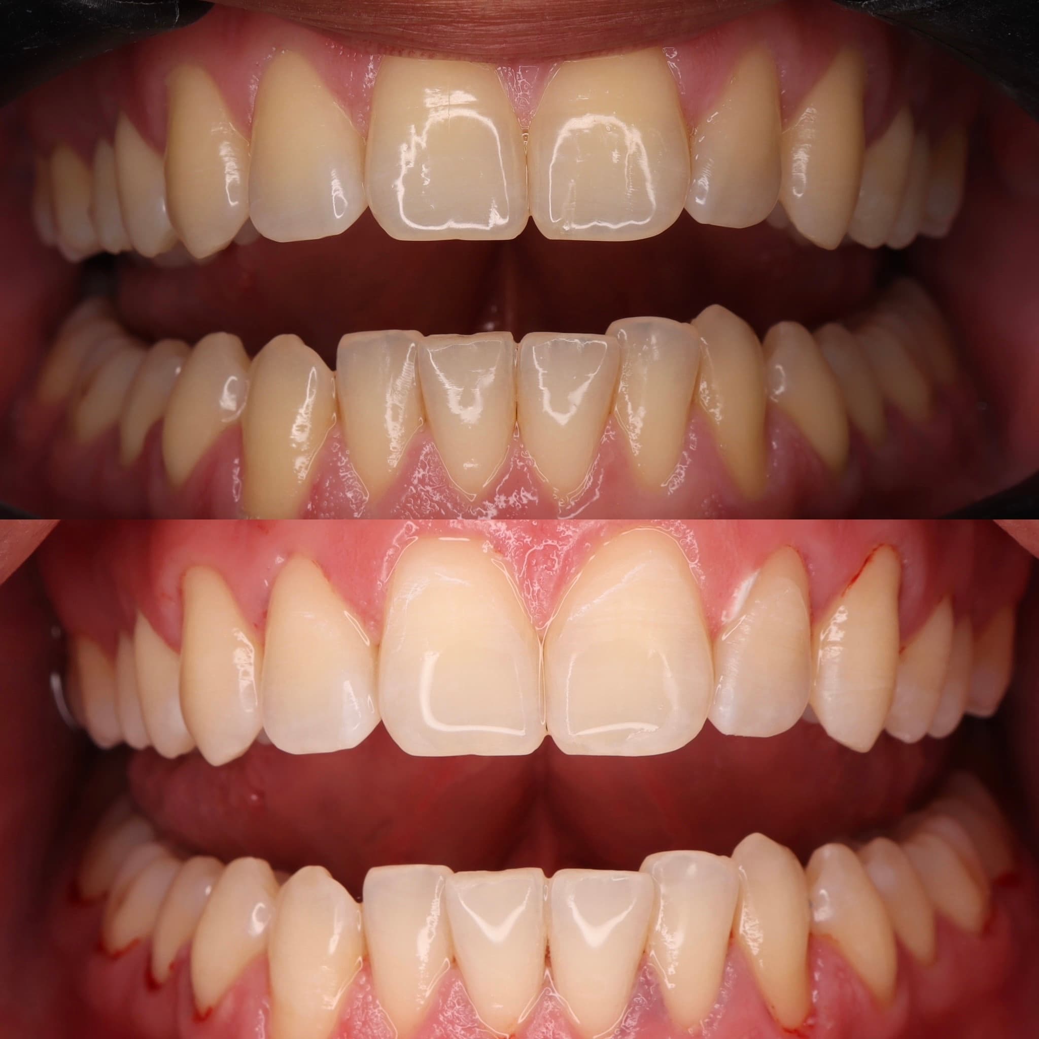 Whitening: before and after dental transformation