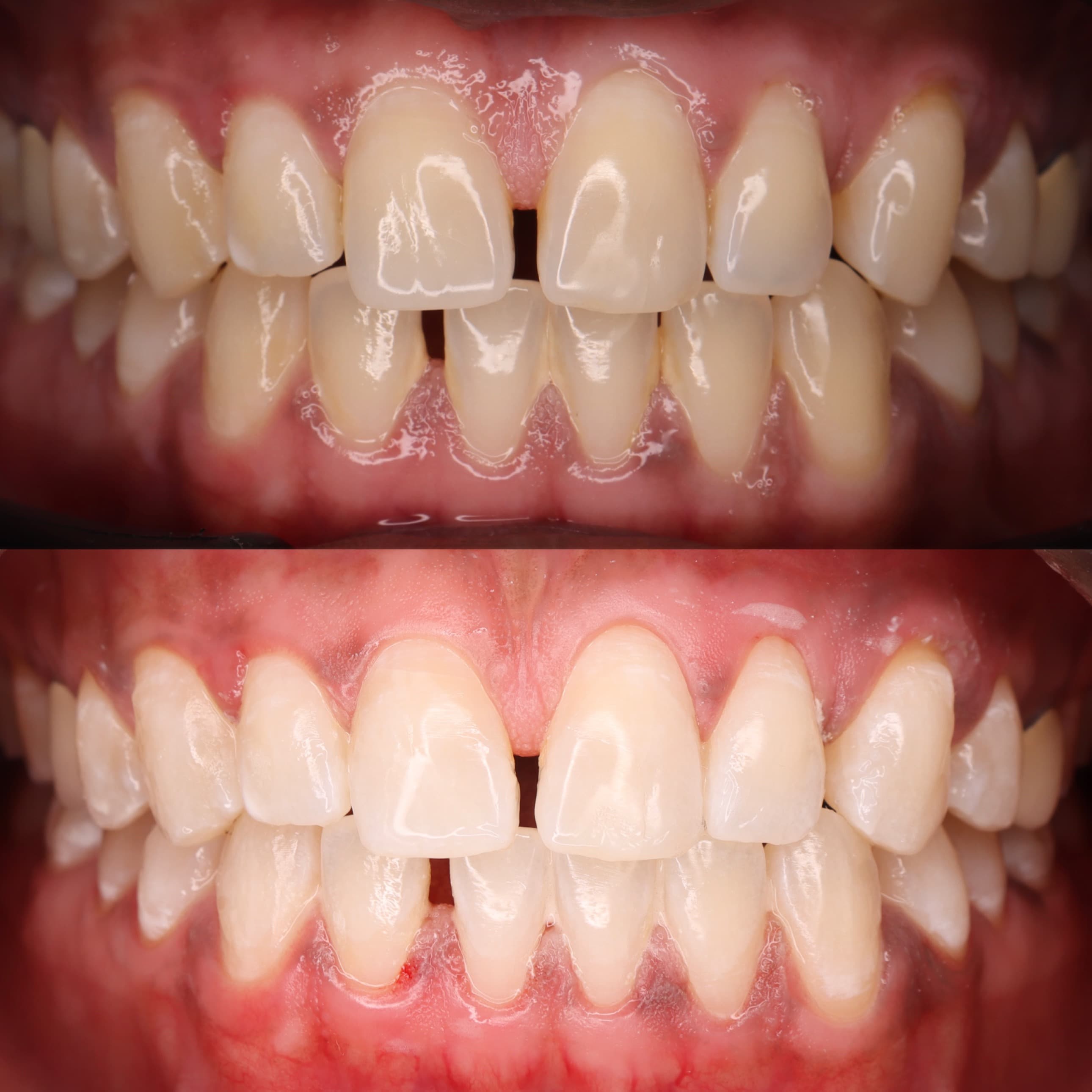 Whitening: before and after dental transformation