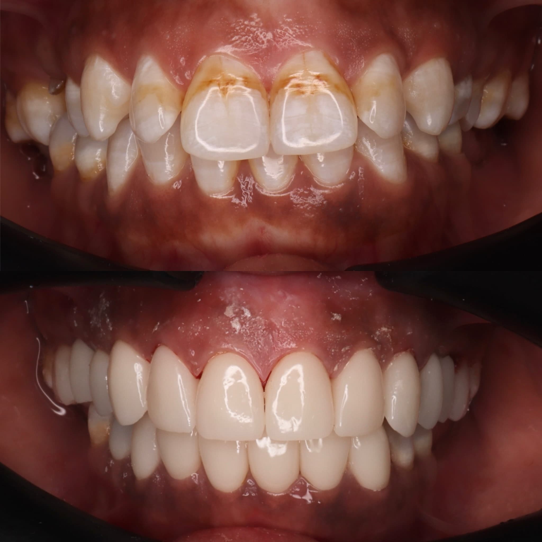 Zirconia Crowns: before and after dental transformation