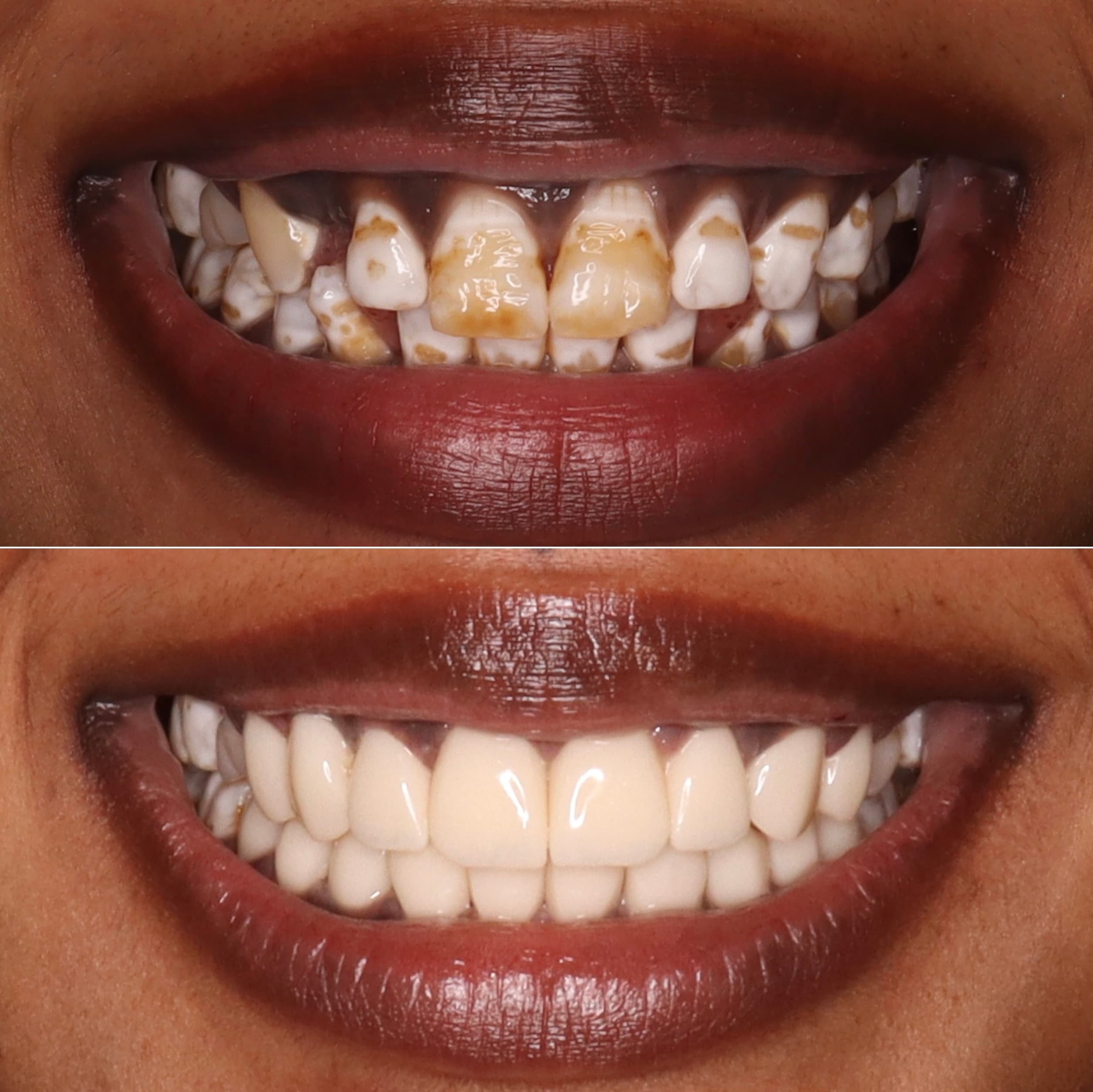 Zirconia crowns: before and after dental transformation