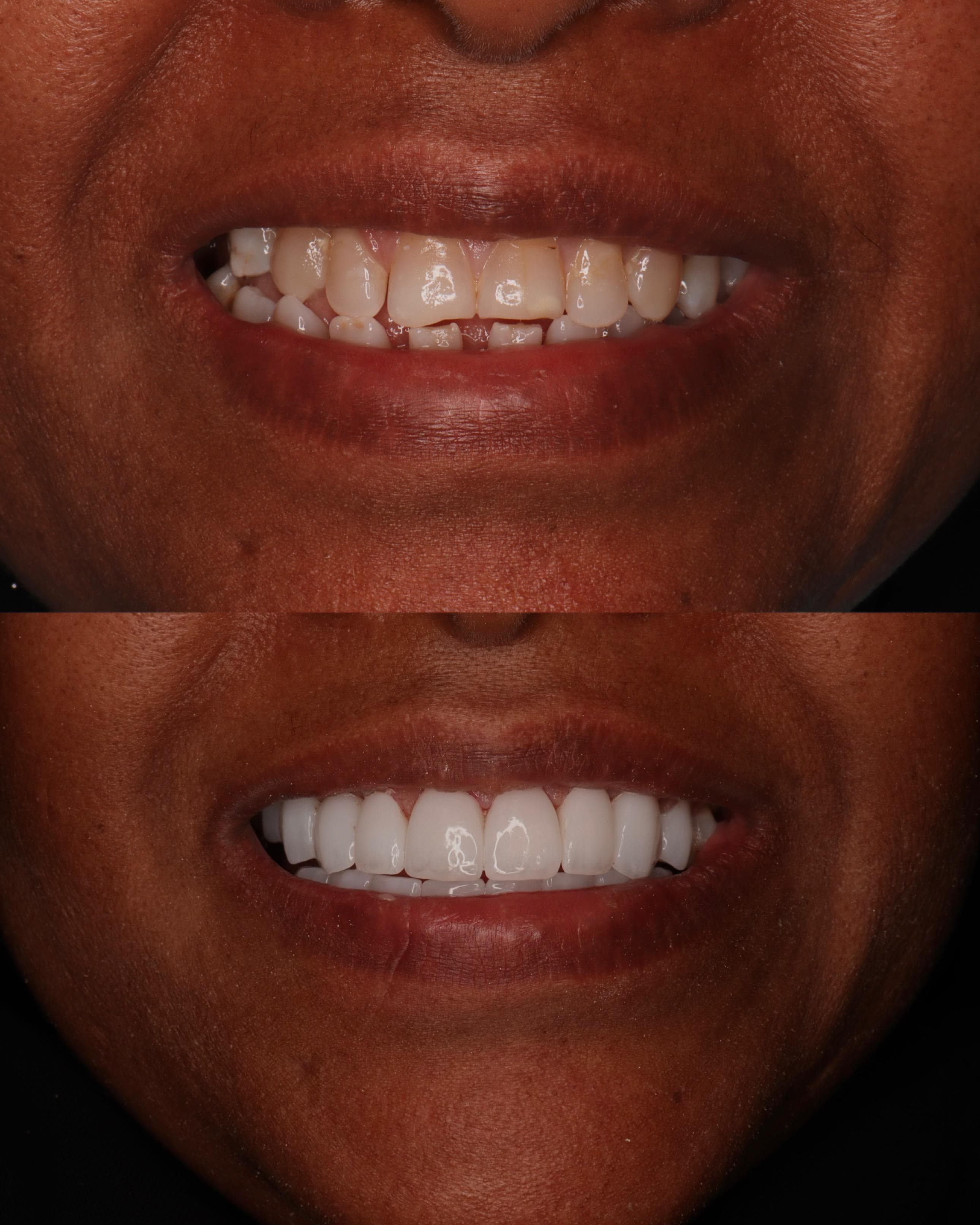 Zirconia Crowns: before and after dental transformation